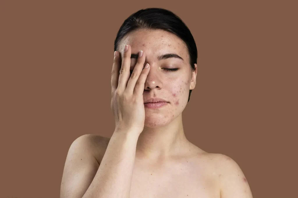 como tratar el acne