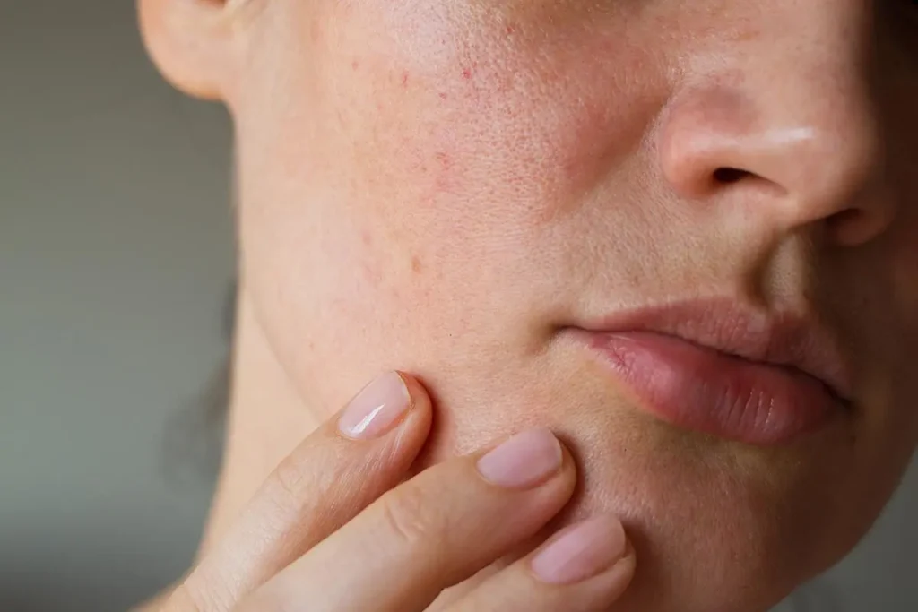 rosacea