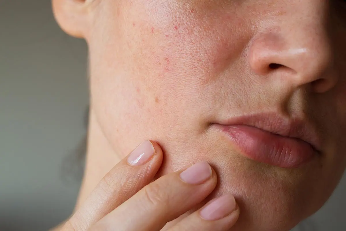 rosacea
